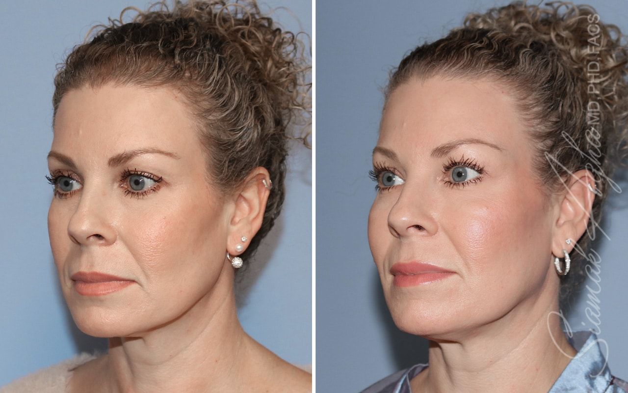 Ellacor Before & After