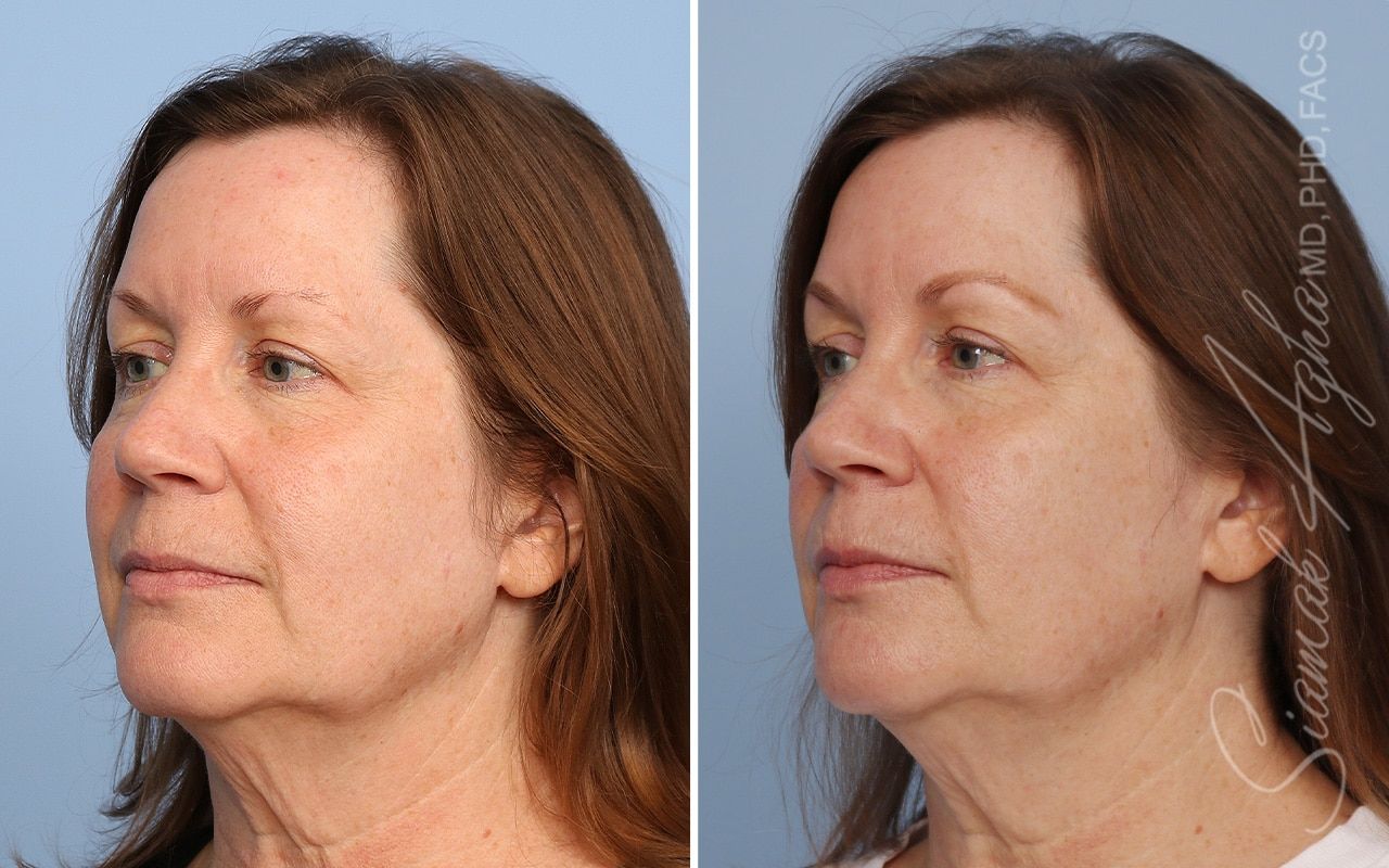 Ellacor Before & After