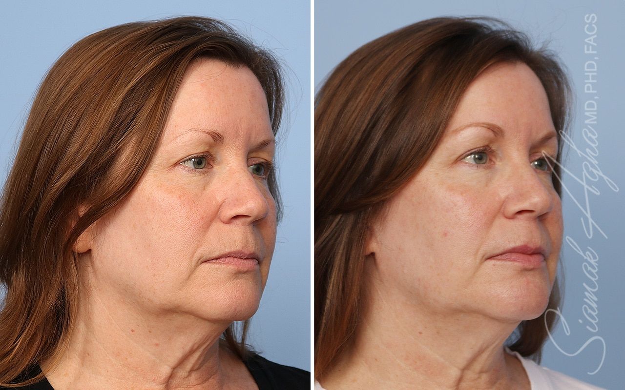 Ellacor Before & After