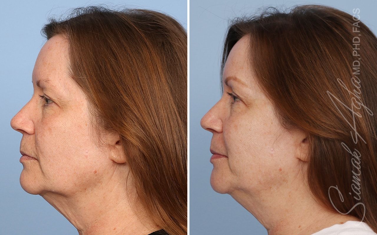 Ellacor Before & After