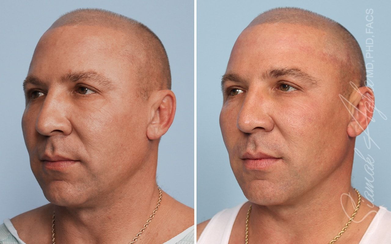 Ellacor Before & After