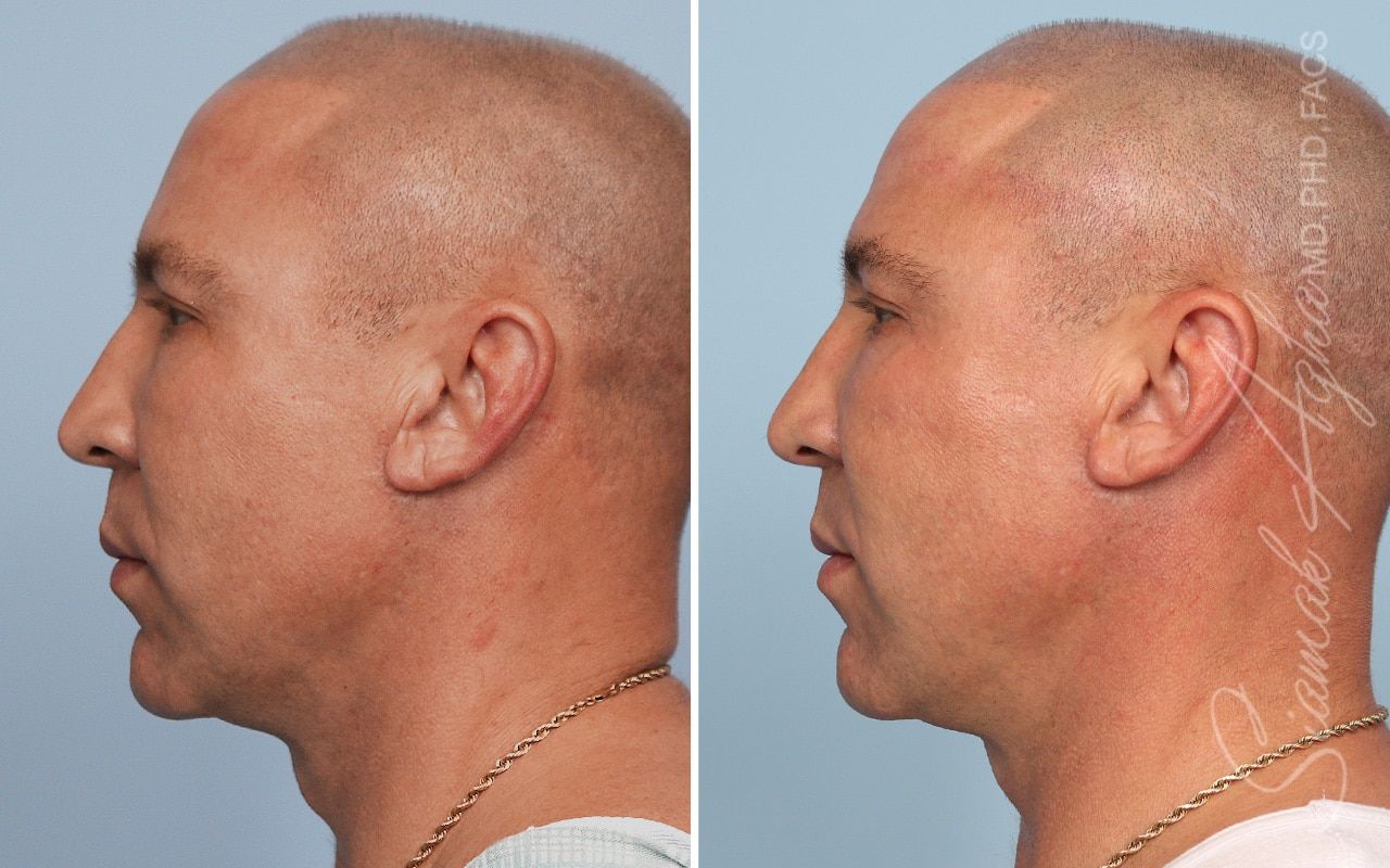 Ellacor Before & After