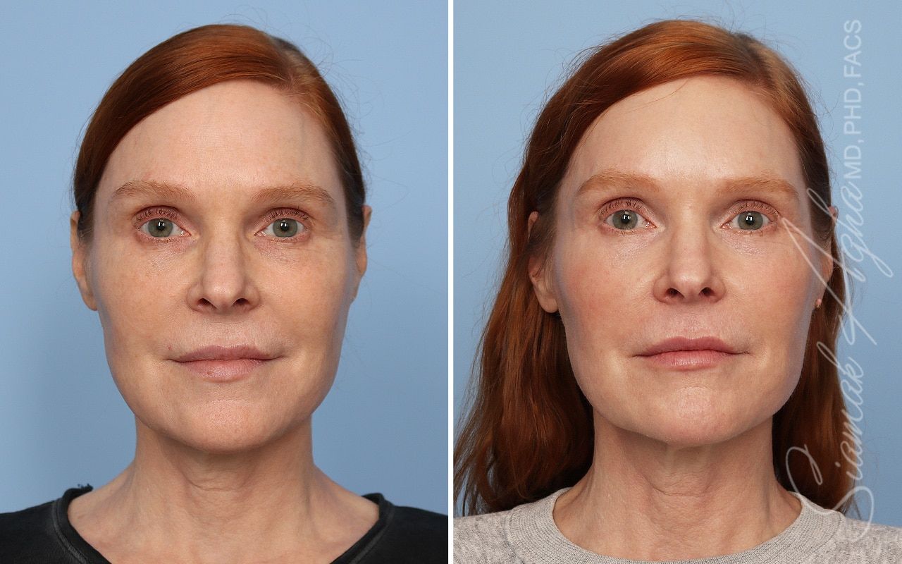 Ellacor Before & After