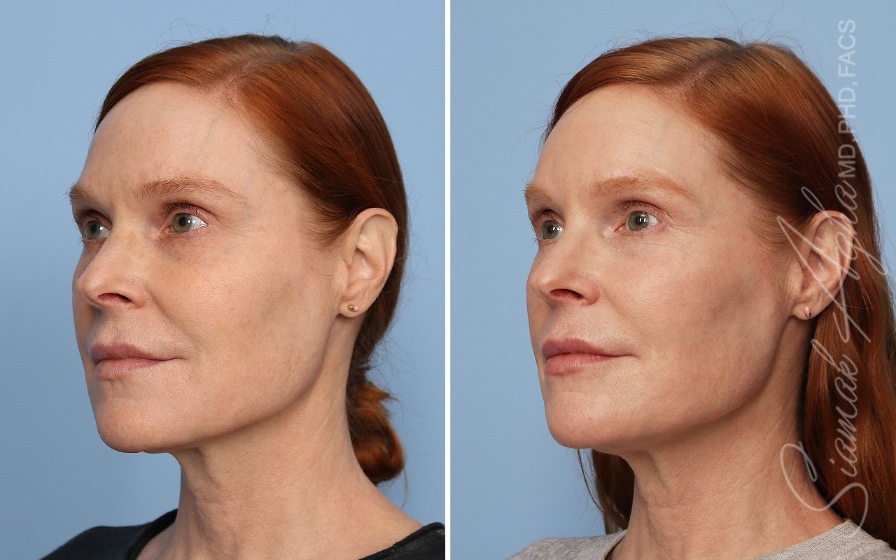 Ellacor Before & After