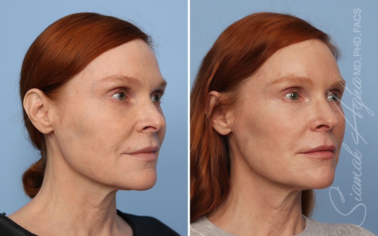 Ellacor Before & After