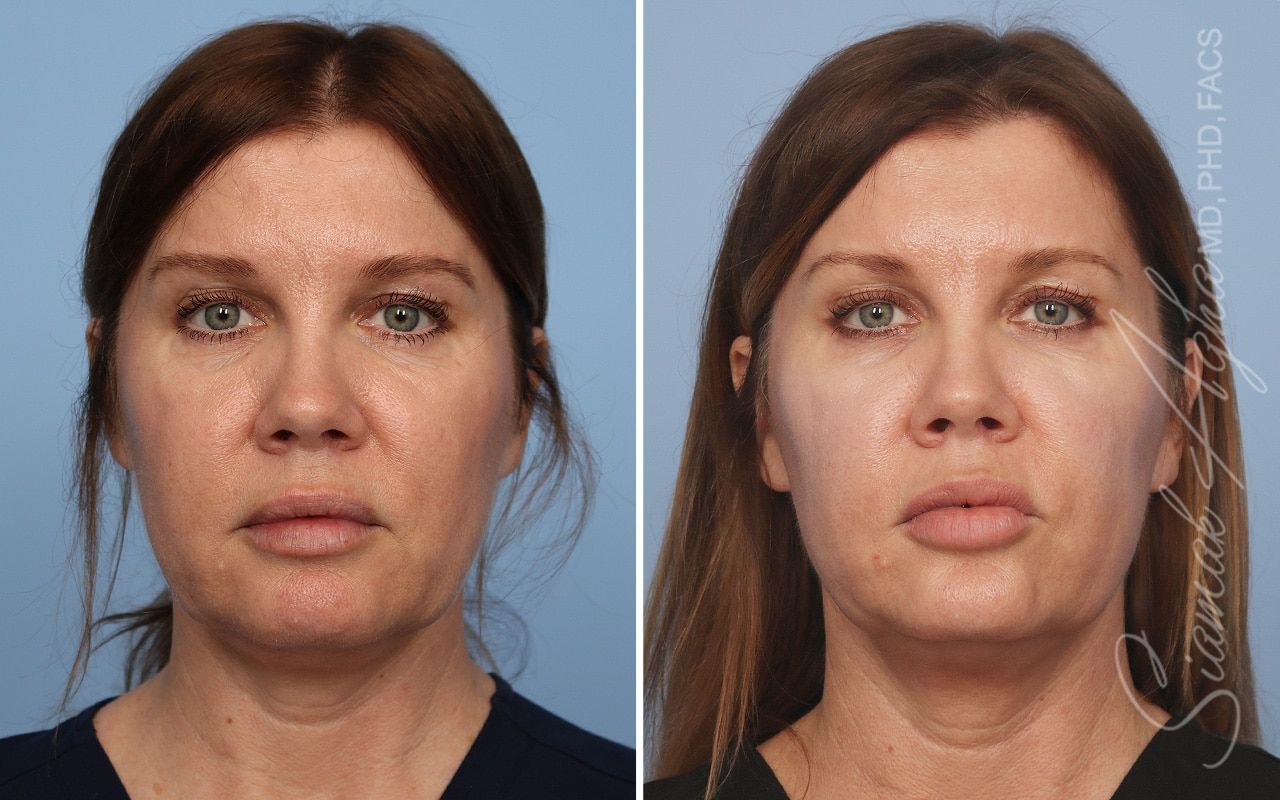 Ellacor Before & After