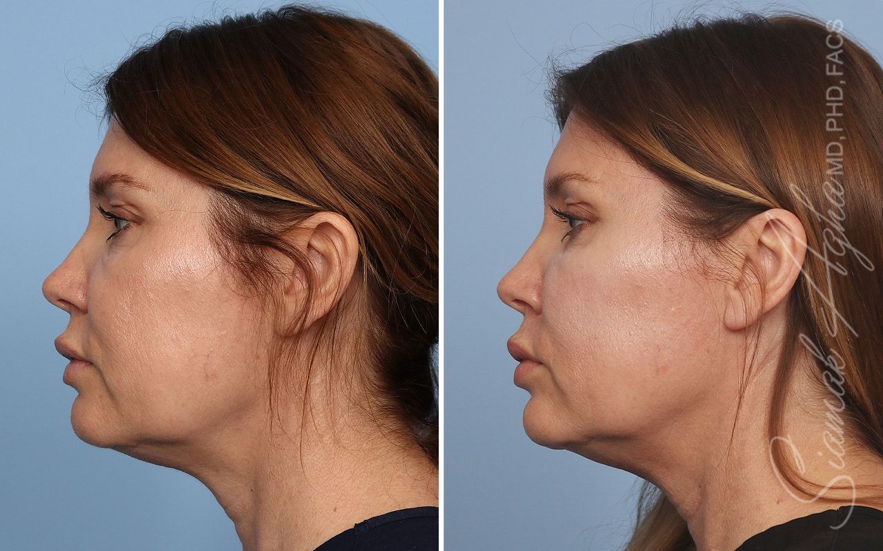 Ellacor Before & After