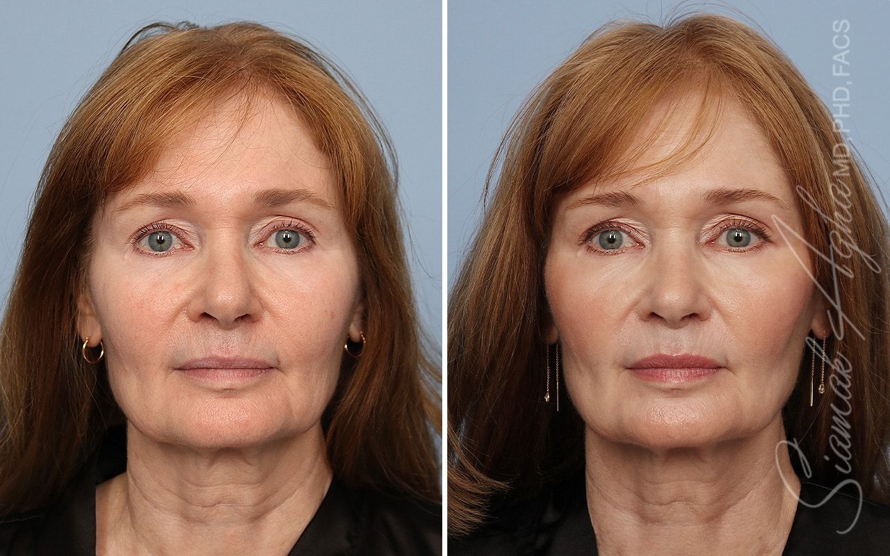 Ellacor Before & After