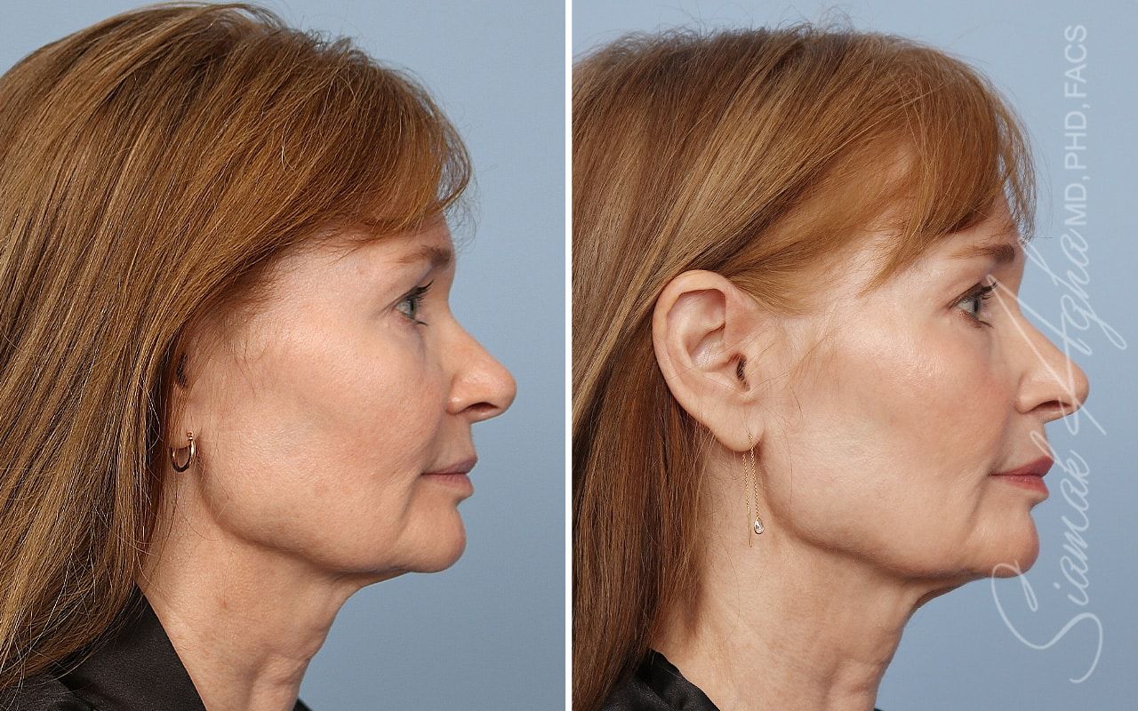 Ellacor Before & After