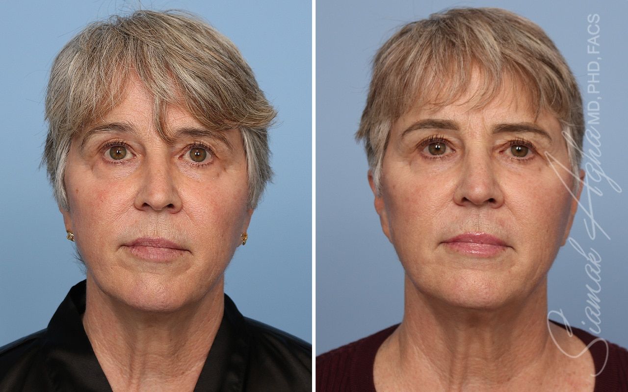 Ellacor Before & After