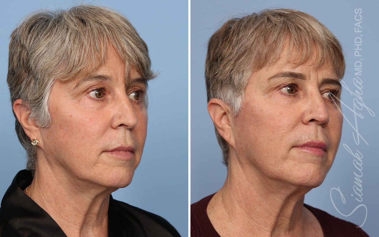 Ellacor Before & After