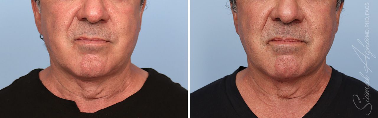 Ellacor Before & After