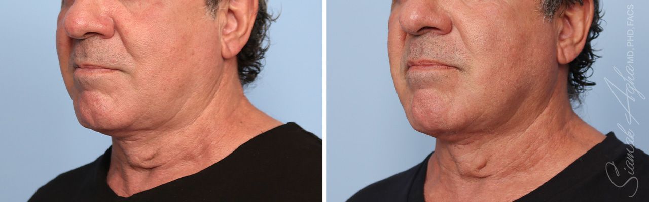 Ellacor Before & After