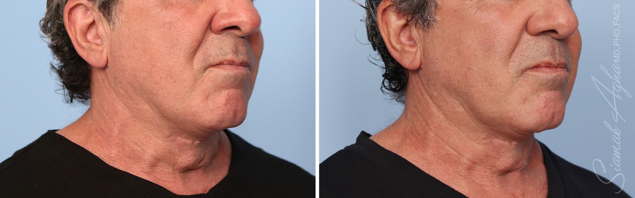 Ellacor Before & After