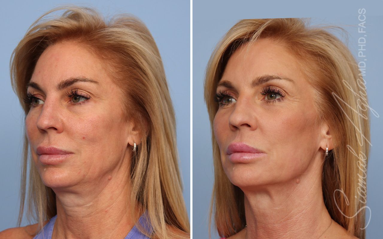 Ellacor Before & After