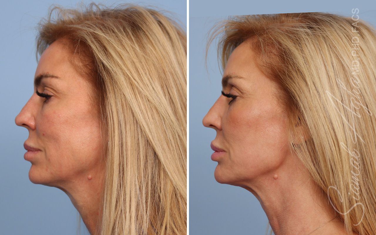 Ellacor Before & After