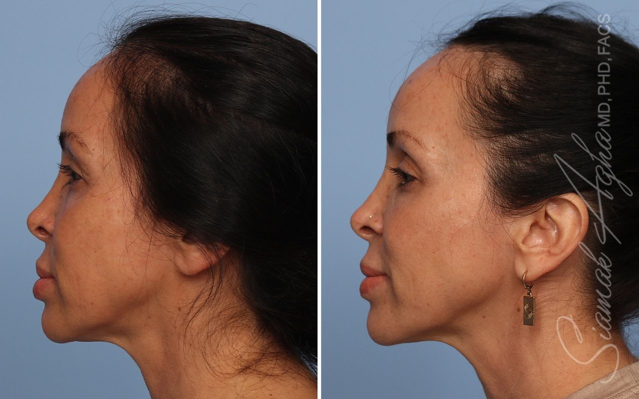 Ellacor Before & After