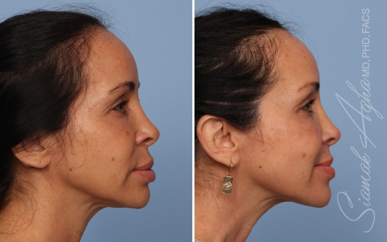 Ellacor Before & After