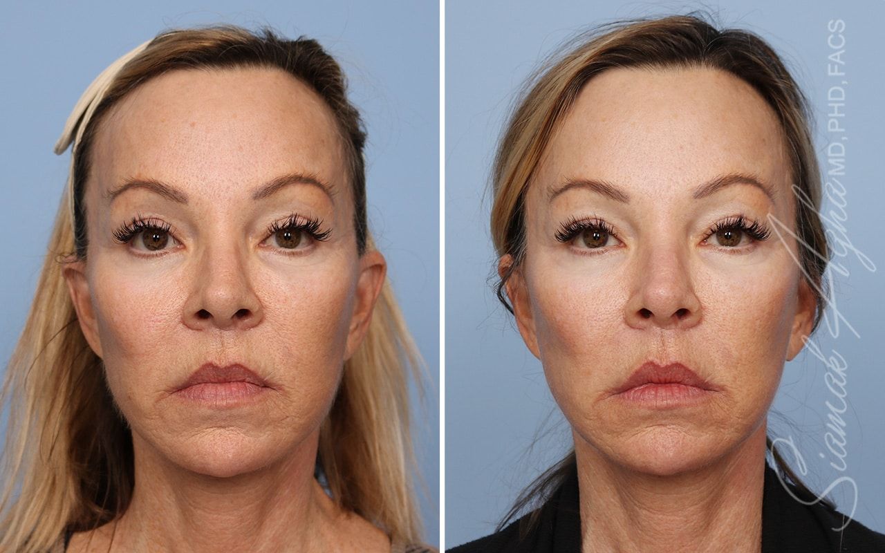 Ellacor Before & After