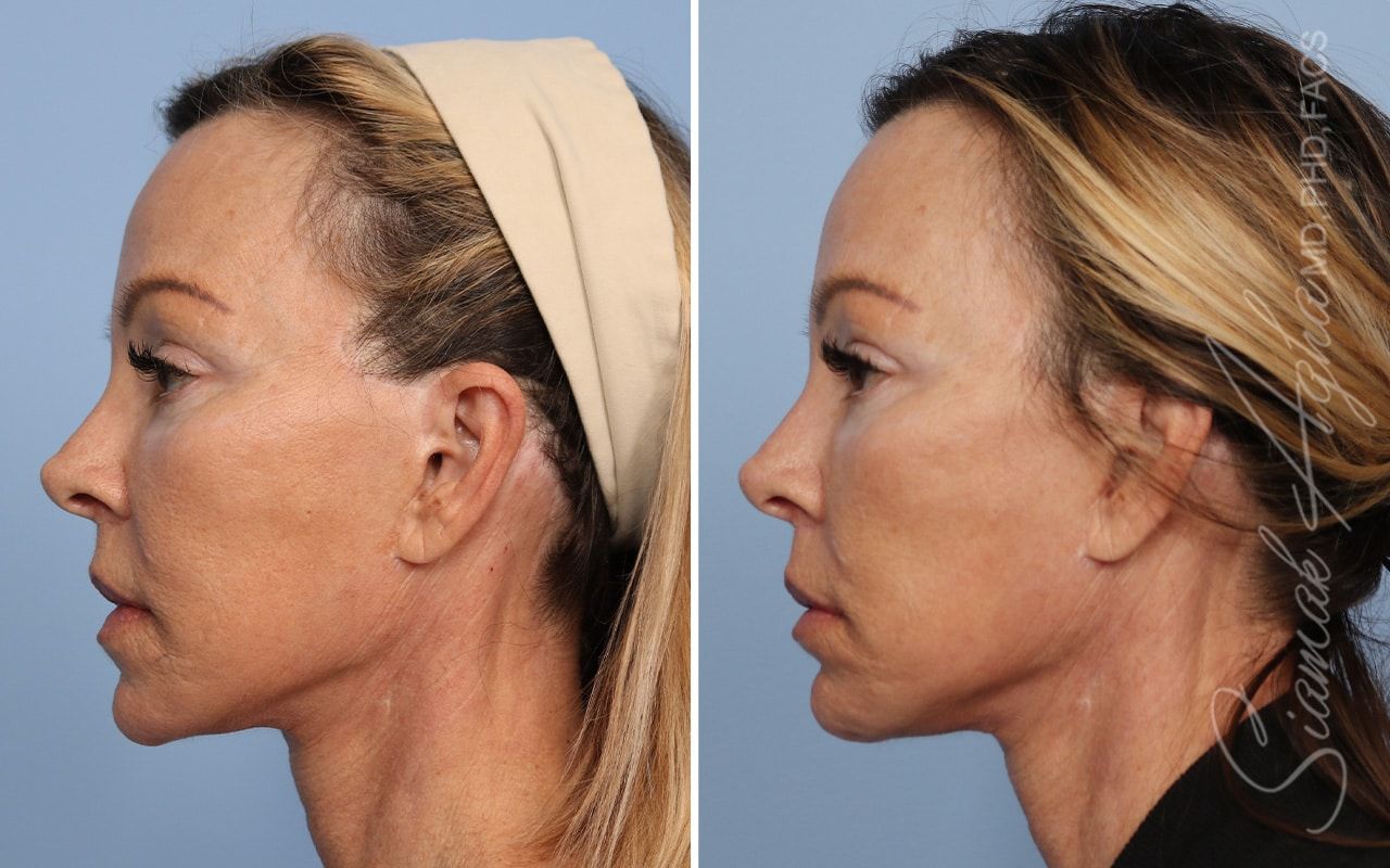 Ellacor Before & After