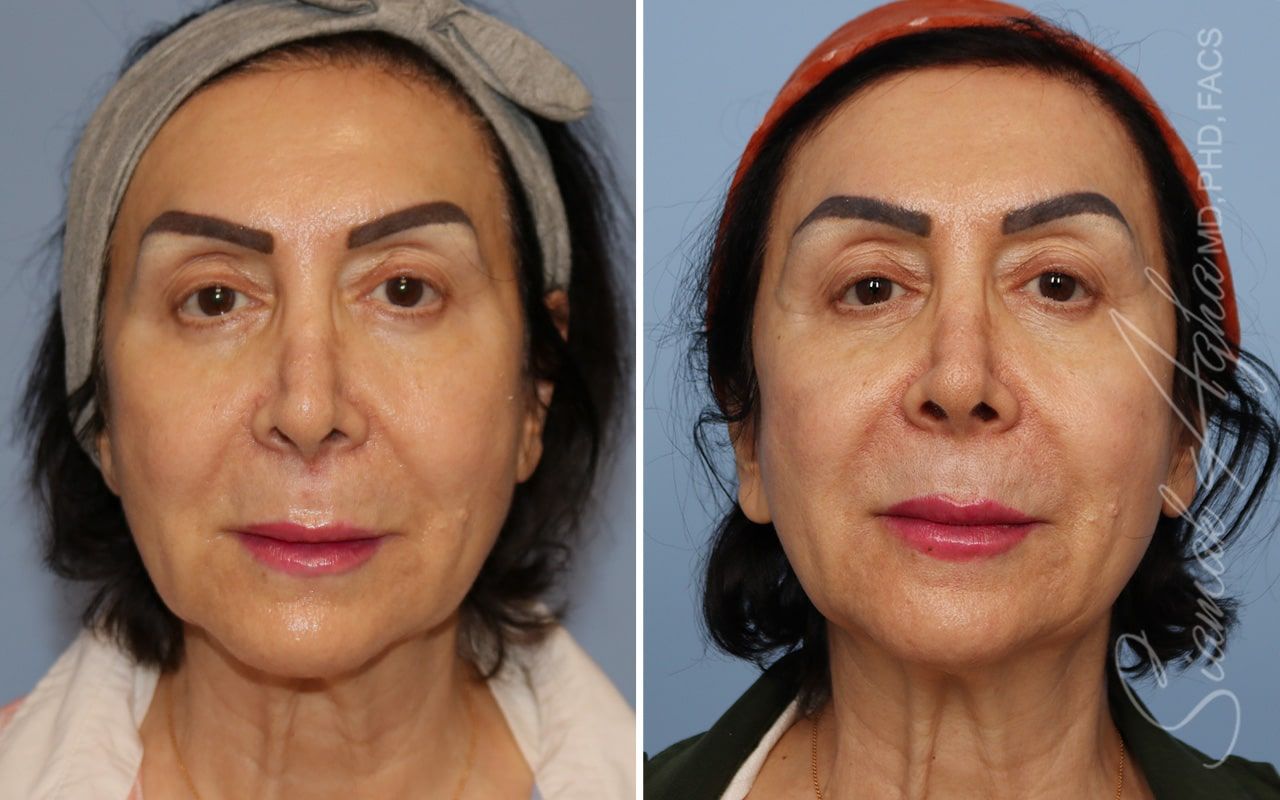 Ellacor Before & After