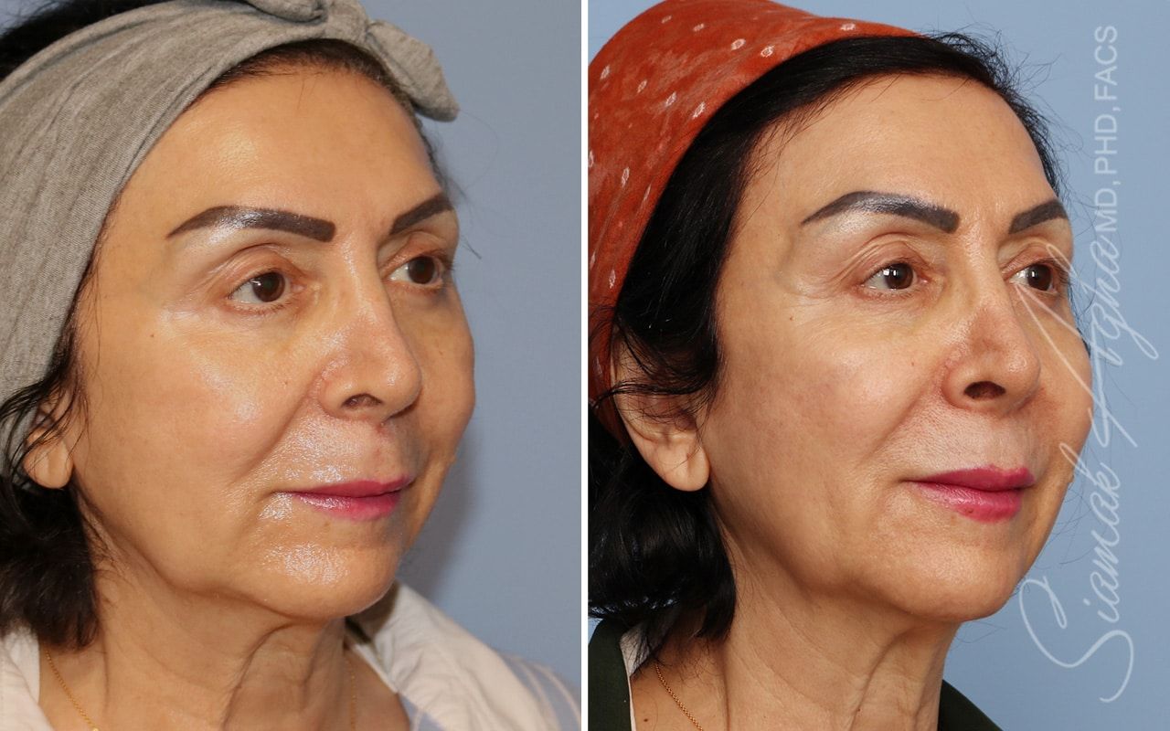 Ellacor Before & After