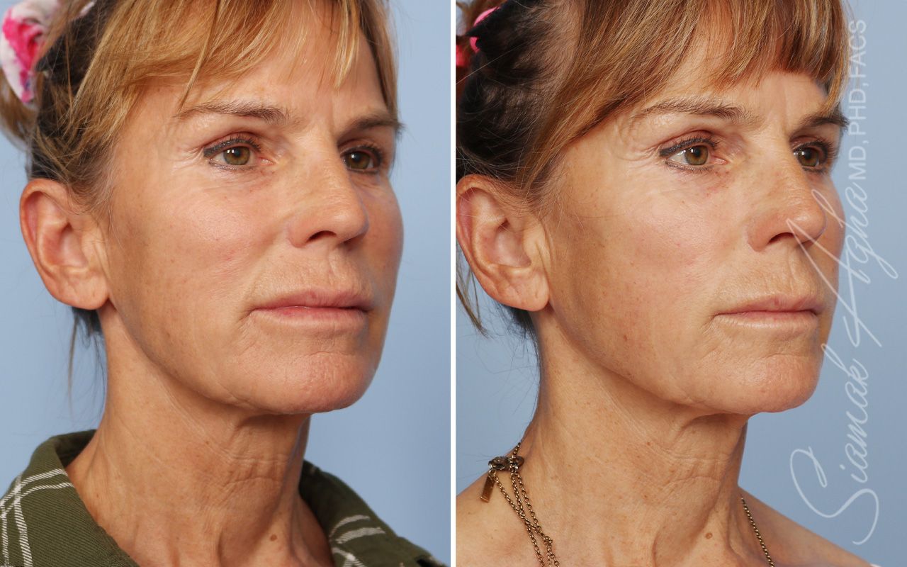 Ellacor Before & After