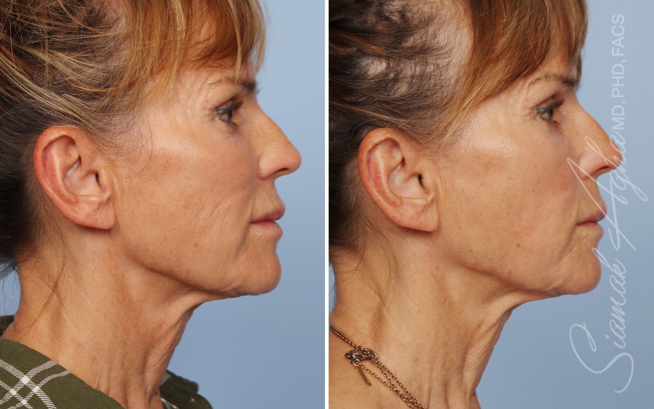 Ellacor Before & After