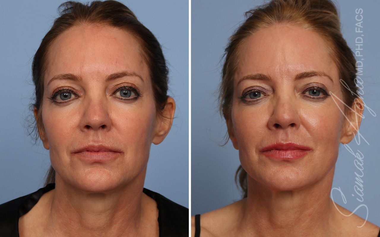 Ellacor Before & After