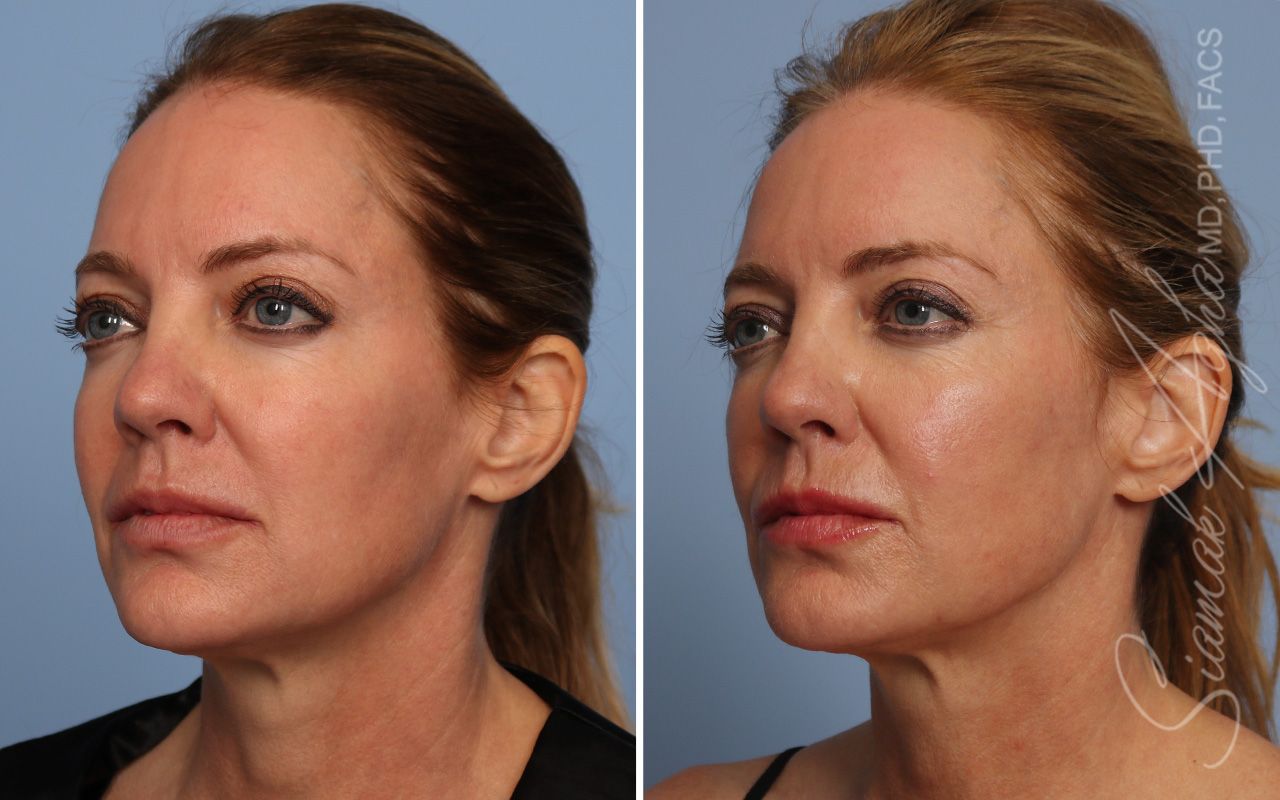 Ellacor Before & After