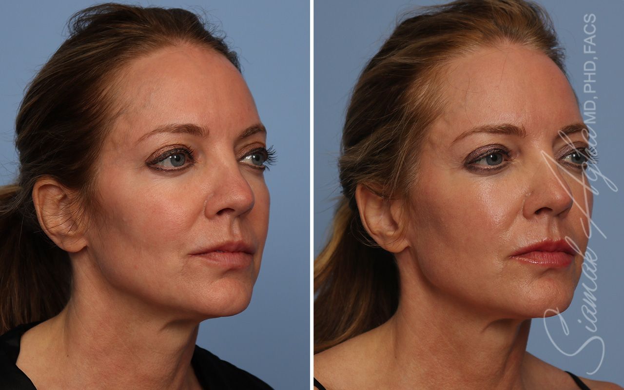 Ellacor Before & After