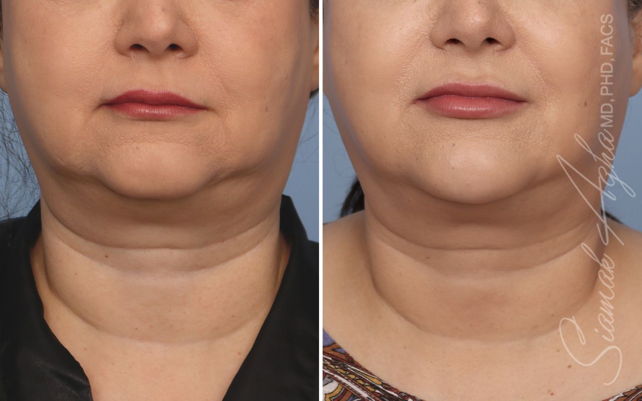 Ellacor Before & After