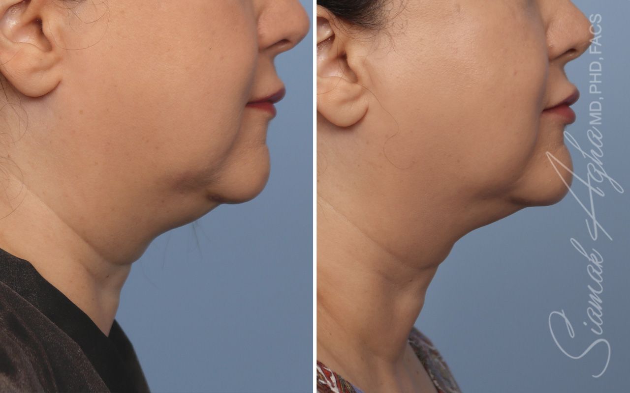 Ellacor Before & After