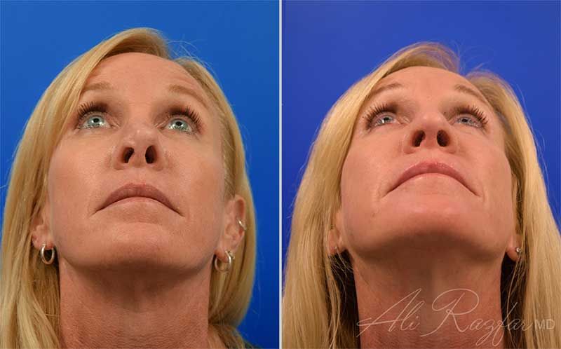 Revision Rhinoplasty Before & After