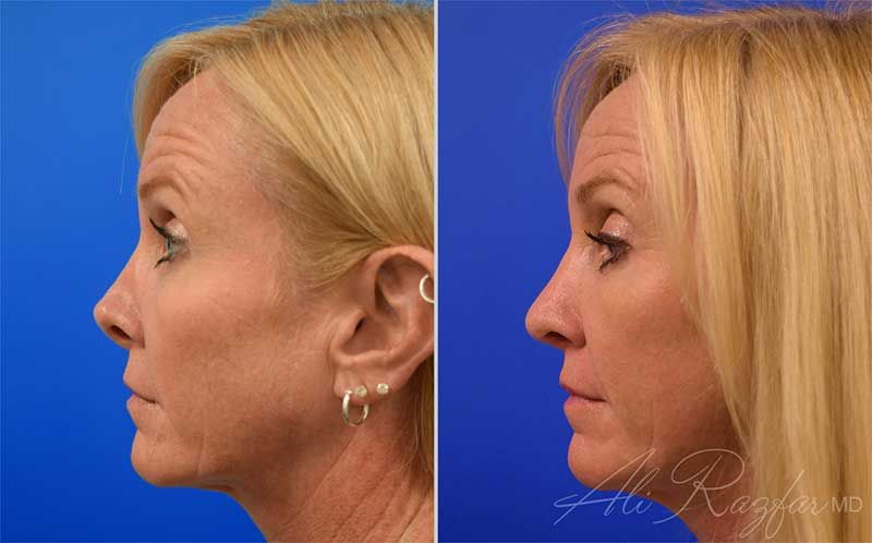Revision Rhinoplasty Before & After