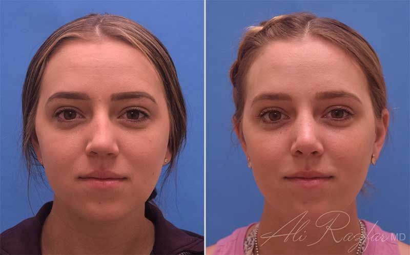 Revision Rhinoplasty Before & After
