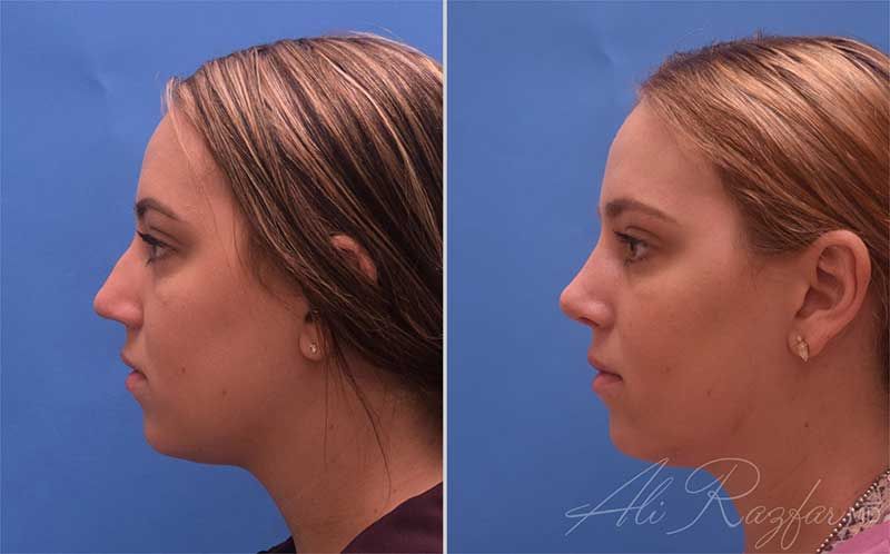 Revision Rhinoplasty Before & After