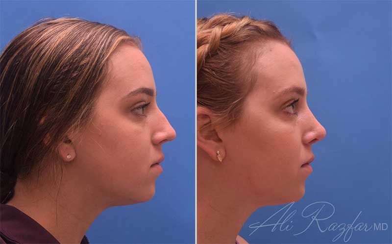 Revision Rhinoplasty Before & After