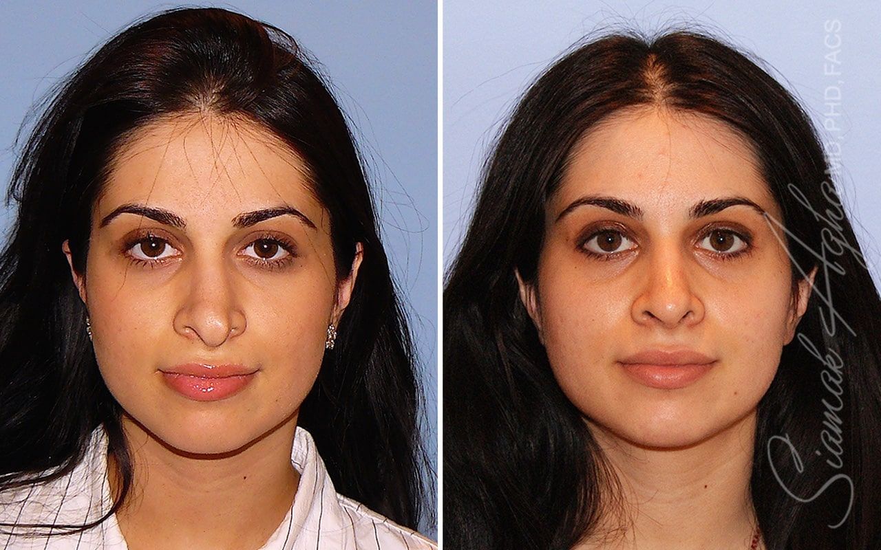 Revision Rhinoplasty Before & After