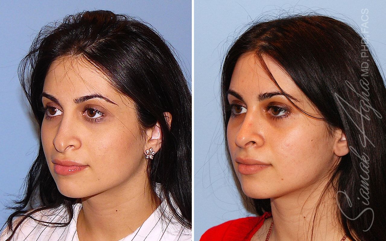 Revision Rhinoplasty Before & After