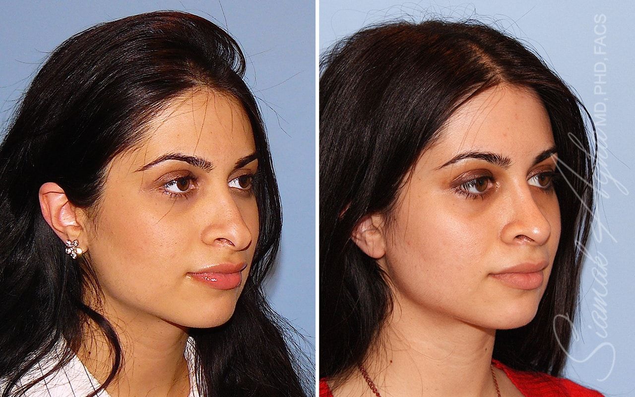 Revision Rhinoplasty Before & After