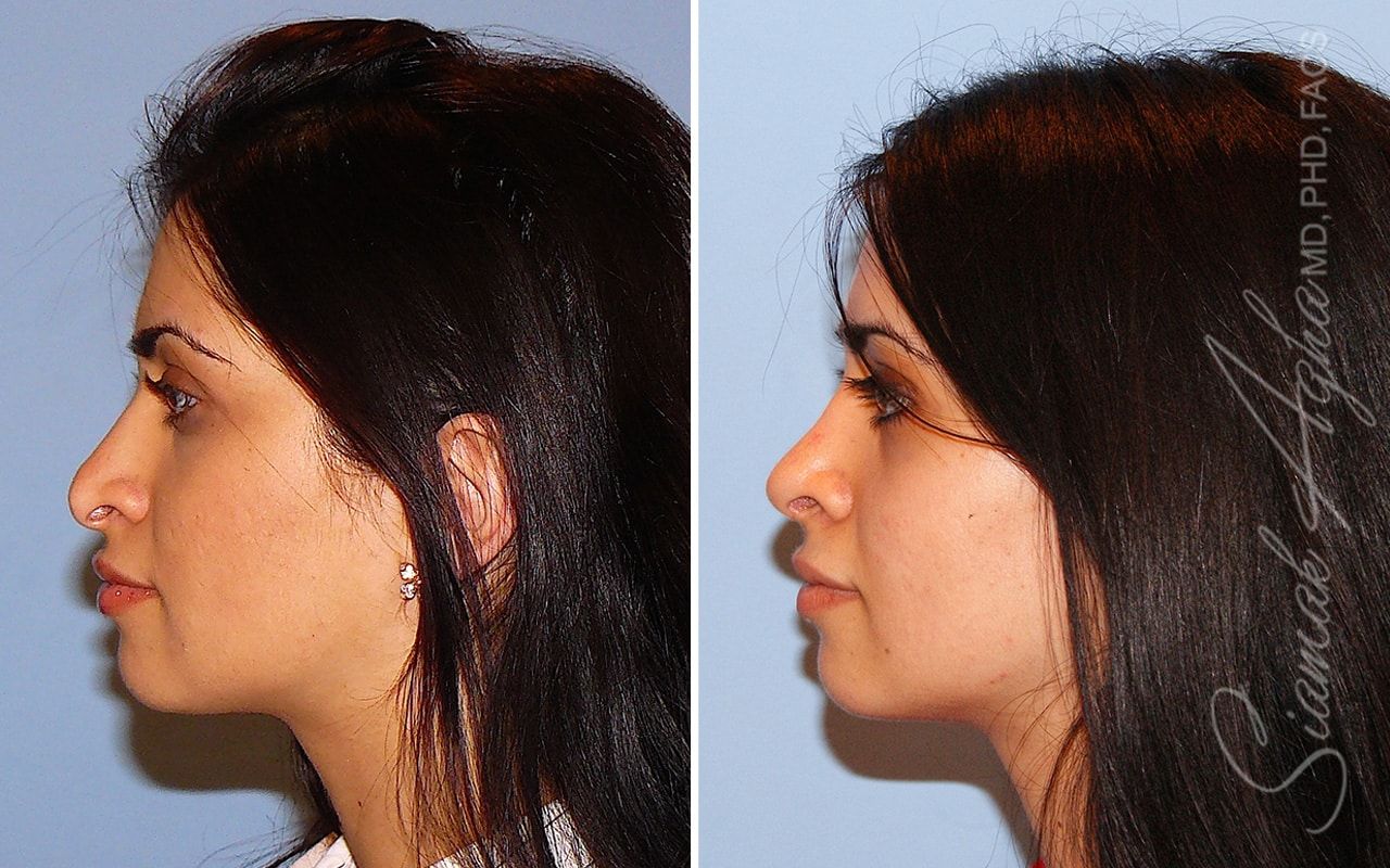 Revision Rhinoplasty Before & After