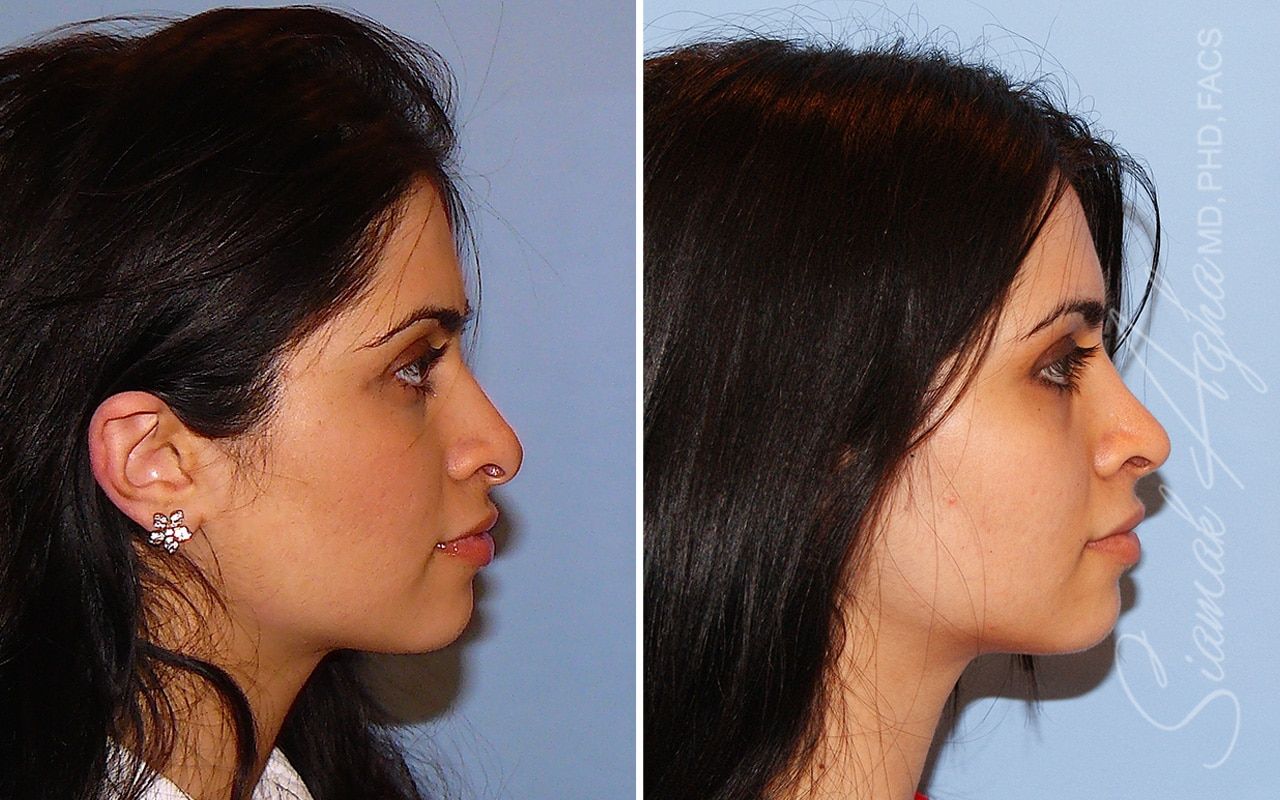 Revision Rhinoplasty Before & After