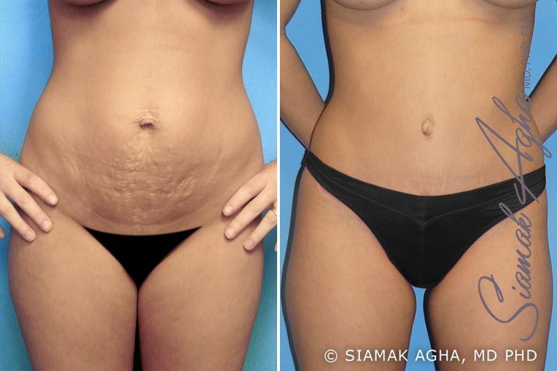 Tummy Tuck Before & After