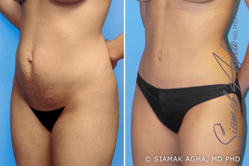 Tummy Tuck Before & After