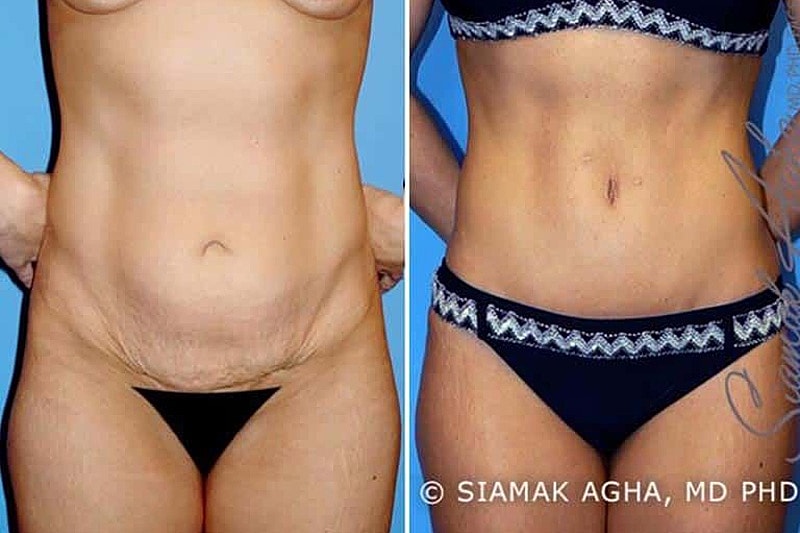 Before and after body transformation comparison image.