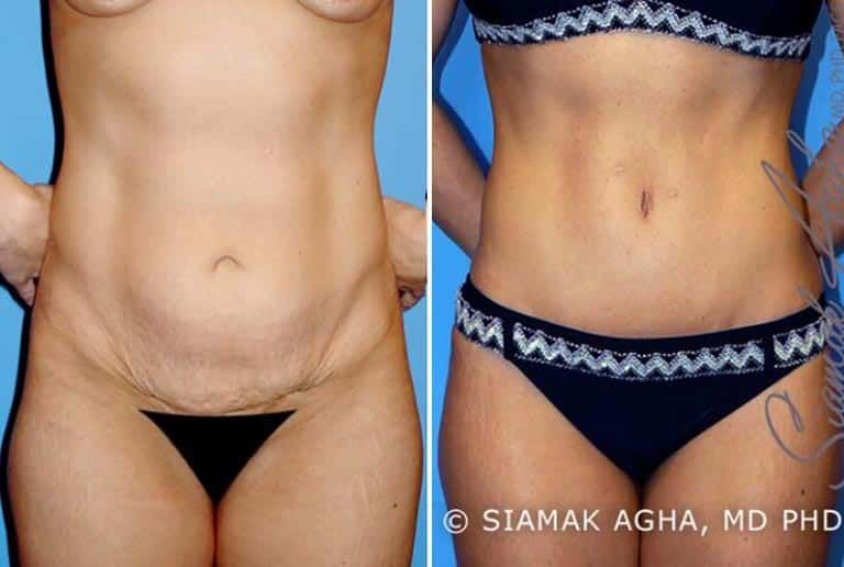 Tummy Tuck Before & After