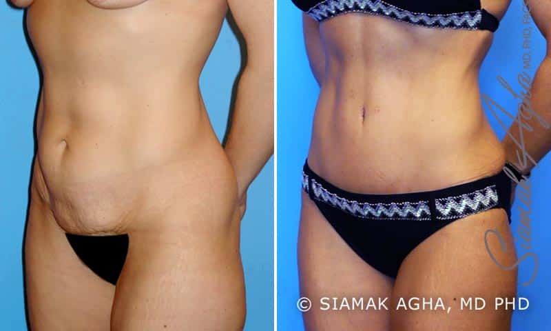 Tummy Tuck Before & After