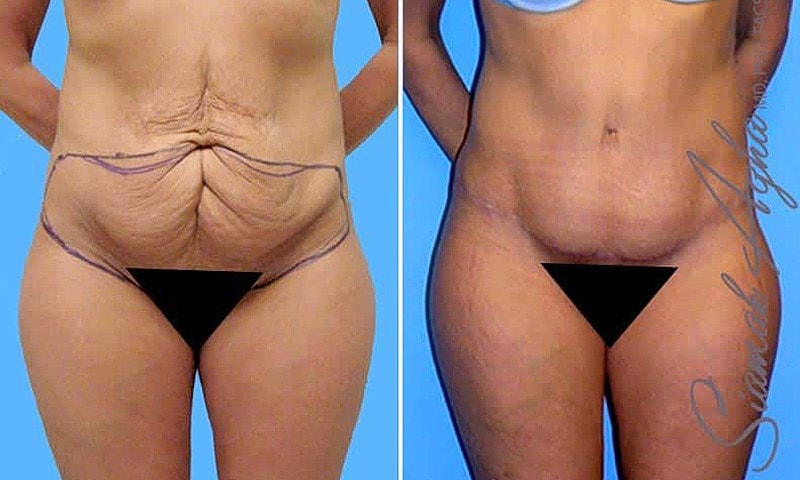 Before and after body contouring procedure images.