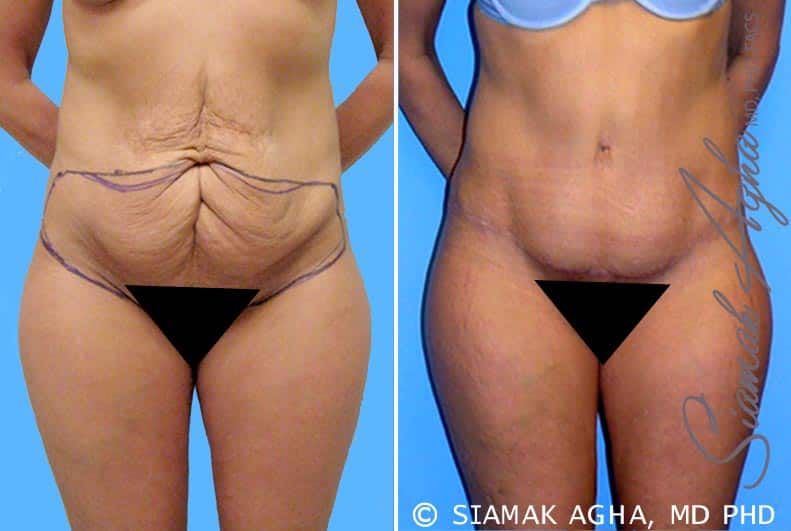 Tummy Tuck Before & After